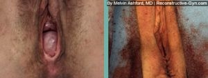 Vaginoplasty